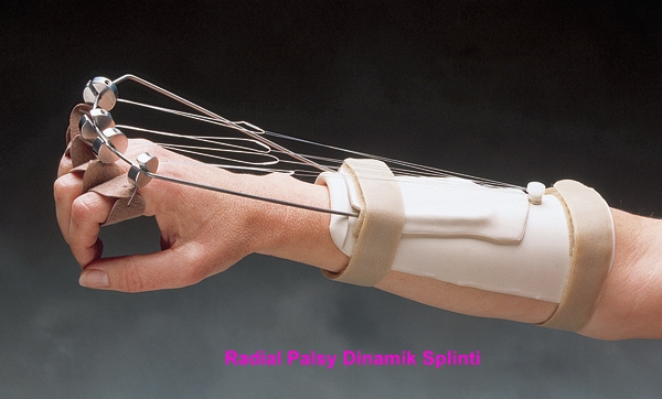 radial palsy